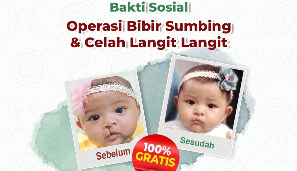 Peduli Sesama RS Cahaya Kembali Gelar Operasi Sumbing Gratis