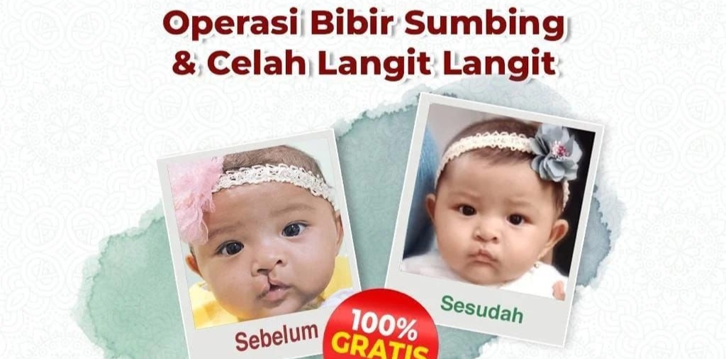 Peduli Warga Kurang Mampu RS Cahaya Gelar Operasi Sumbing Gratis